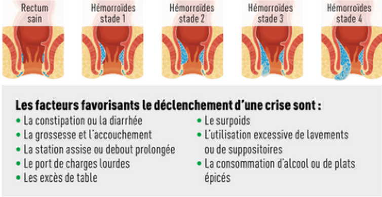 Hémorroïdes : facteurs favorisants et symptômes